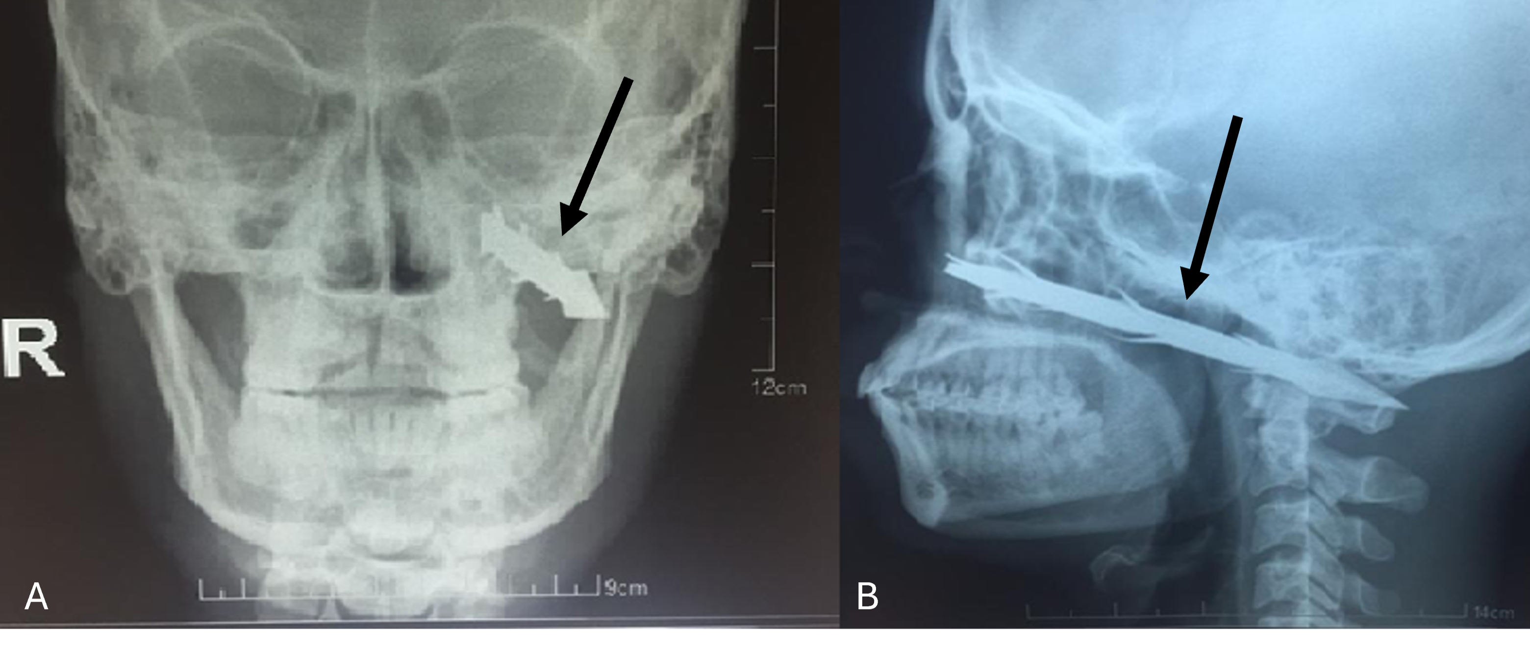 					View Vol. 37 No. 1 (2024): Management of penetrating arrow injury of the maxillofacial region, case report
				